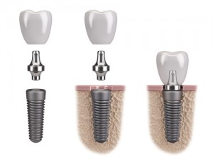 implantes dentales pampona precios