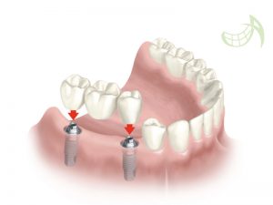 Implantes dentales pamplona